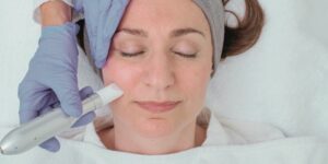 Kundin bei Microneedling-Behandlung in Stuttgart