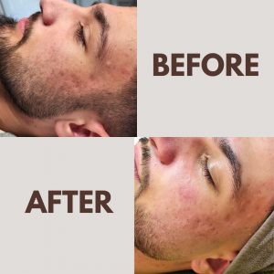 vorher nachher bild kosmetikbehandlung kosmetikstudio beauty balance stuttgart